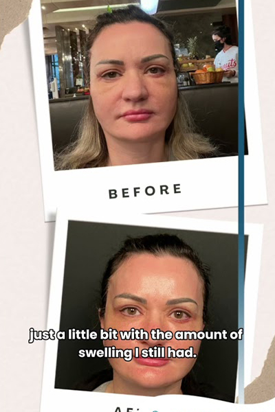 Face Lift Istanbul Clinichub