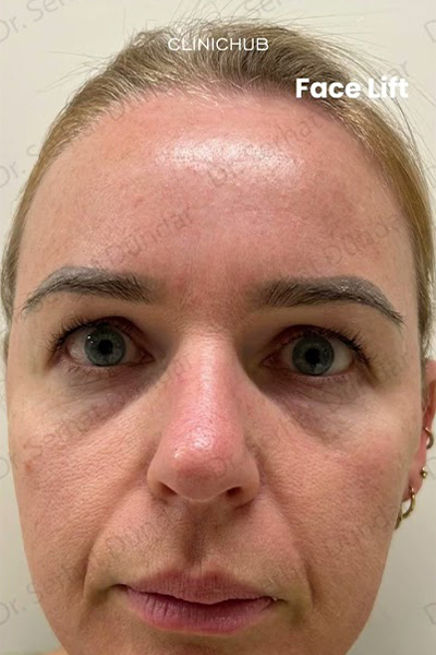 Face Lift Turkey Clinichub