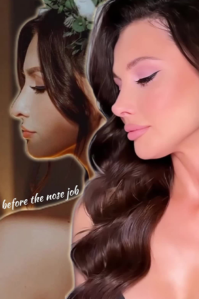 Rhinoplasty Before After Clinichub
